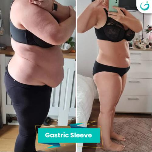 Gastric Sleeve Before / After photo